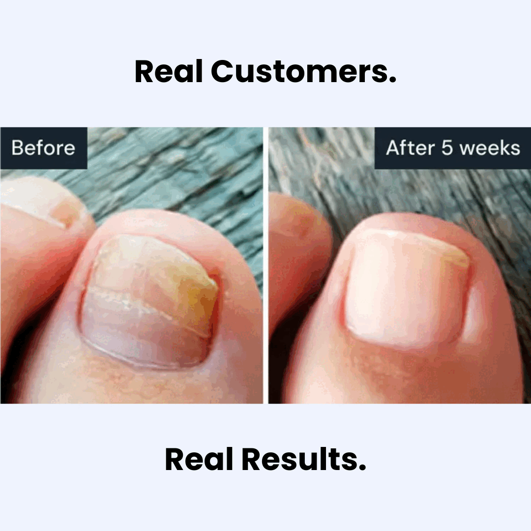 CL™ Antifungal Pen
